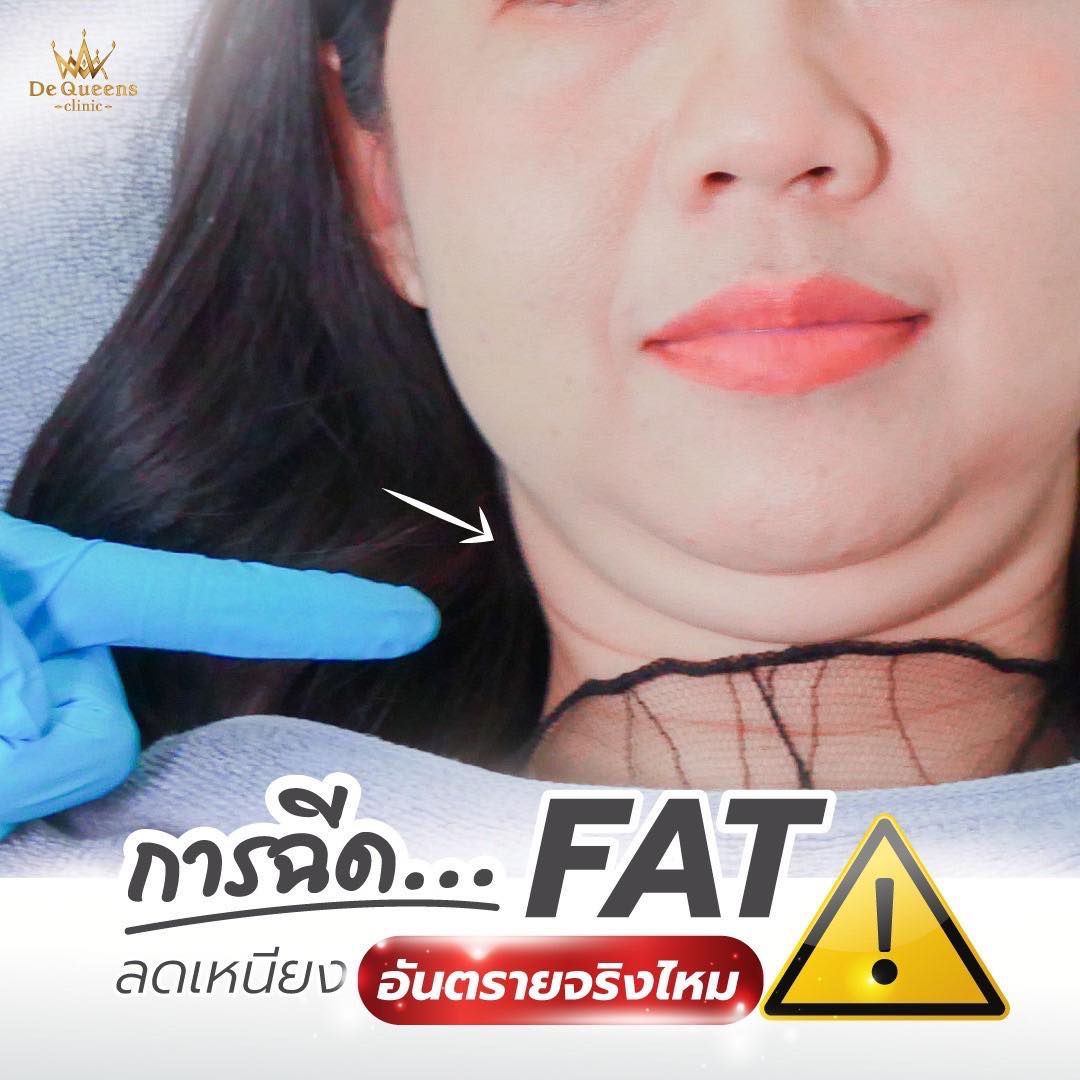การฉีด Fat ลดเหนียงอันตรายจริงไหม?