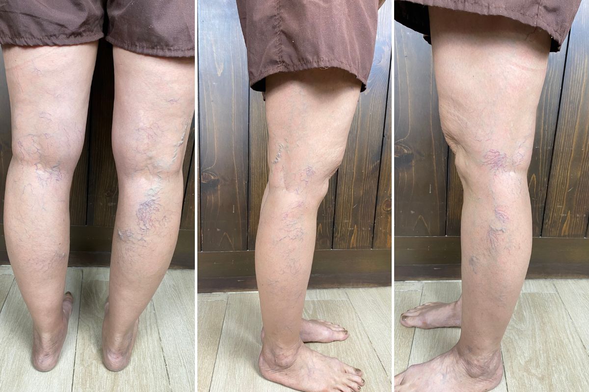 เส้นเลือดขอดลักษณะใยแมงมุม Spider Veins
