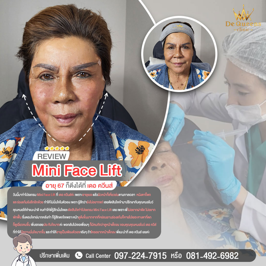รีวิวปล่อยให้อายุเป็นเพียงแค่ตัวเลข เพราะ 67 ก็ตึงได้ ด้วย Mini Face Lift