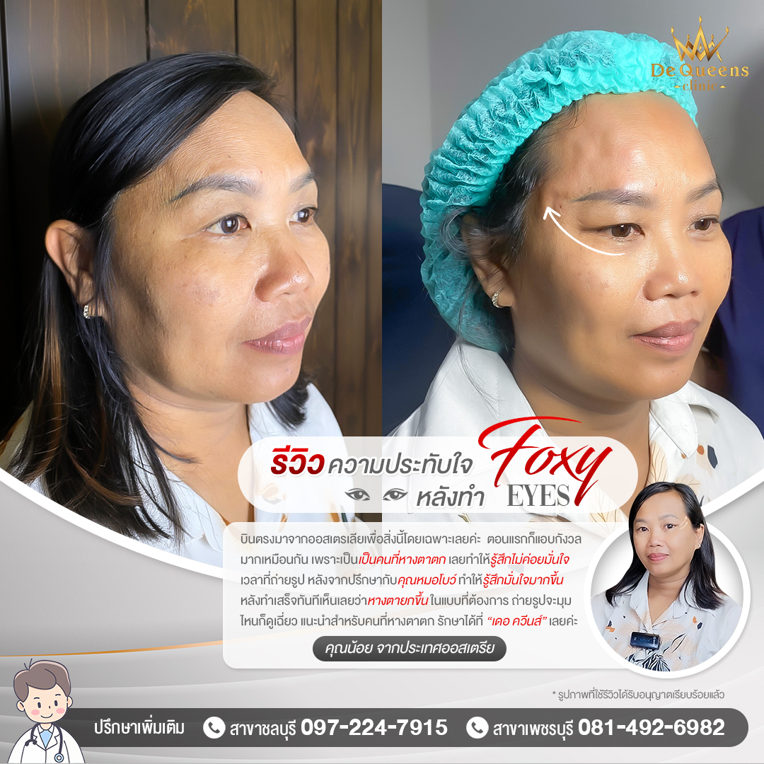 รีวิว Foxy Eyes คุณน้อย จากประเทศออสเตรเลีย