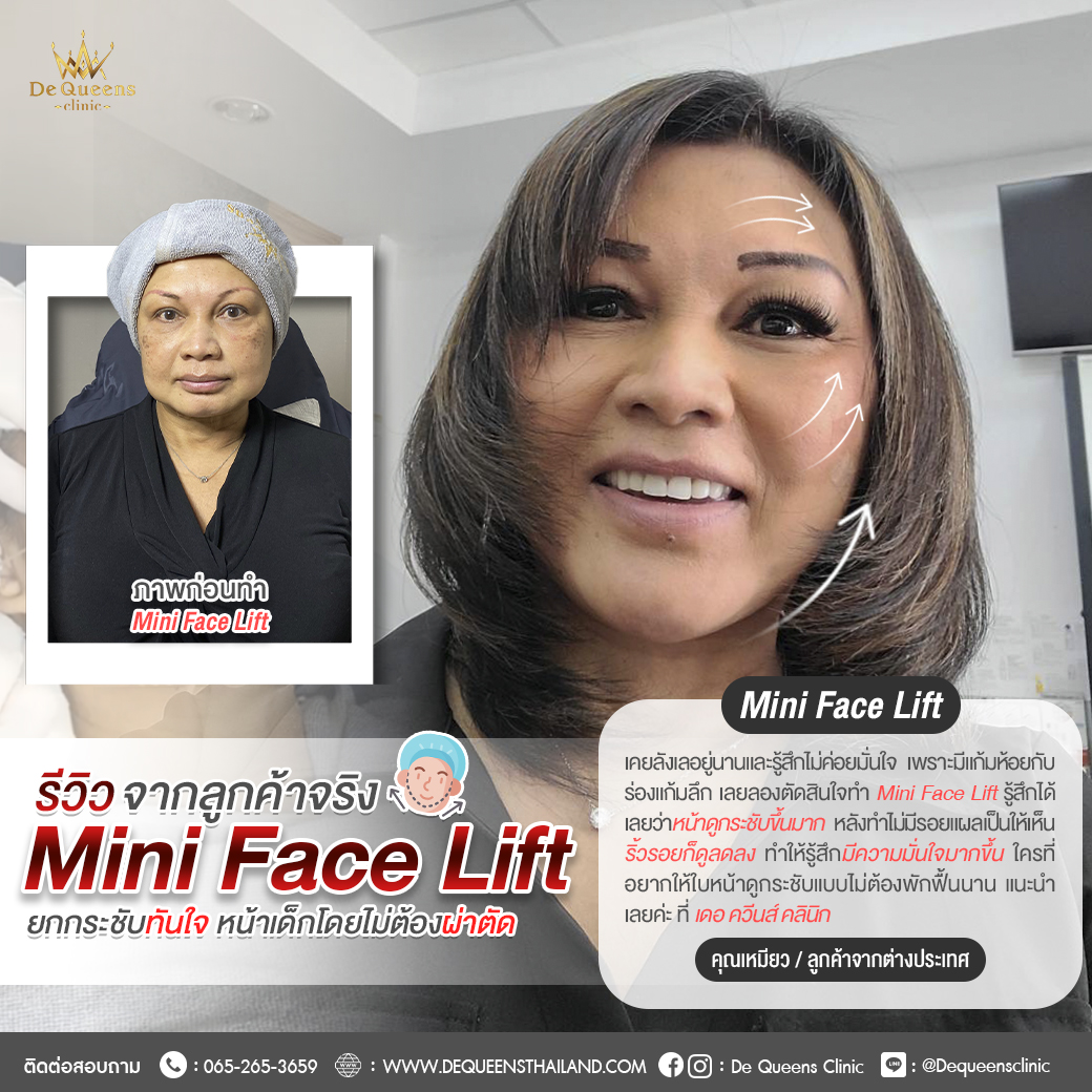 รีวิว Mini Face Lift คุณเหมียว บินจากแคนาดา