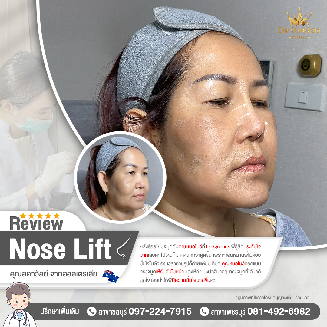 รีวิว Nose Lift คุณลดาวัลย์ จากออสเตรเลีย