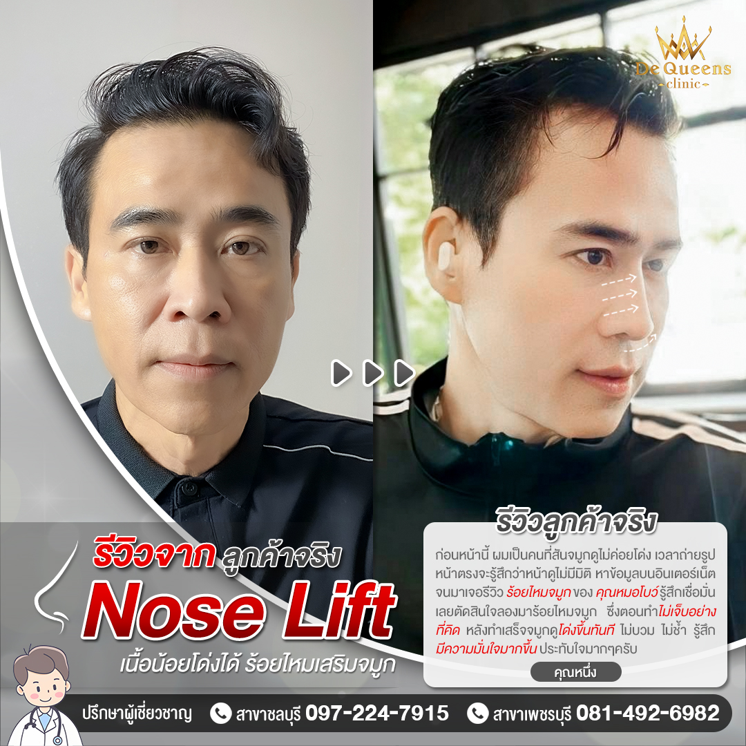 รีวิว Nose Lift คุณหนึ่ง ต้องการให้ใบหน้ามีมิติ ถ่ายรูปได้มั่นใจขึ้น