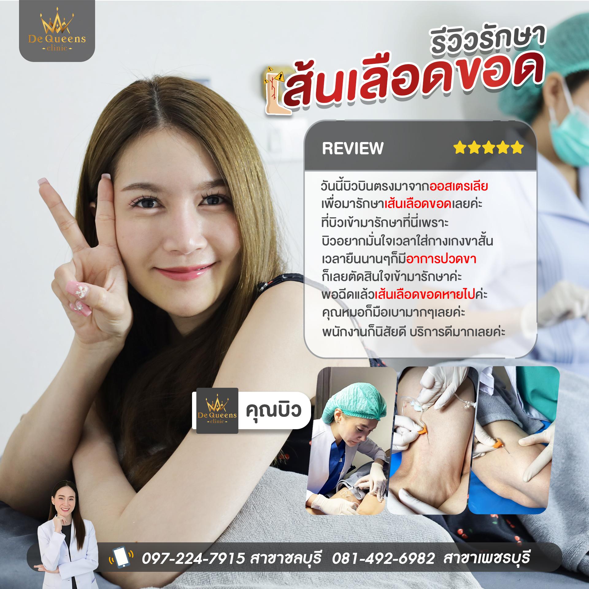 รีวิวรักษาเส้นเลือดขอด คุณบิวจากออสเตรเลีย