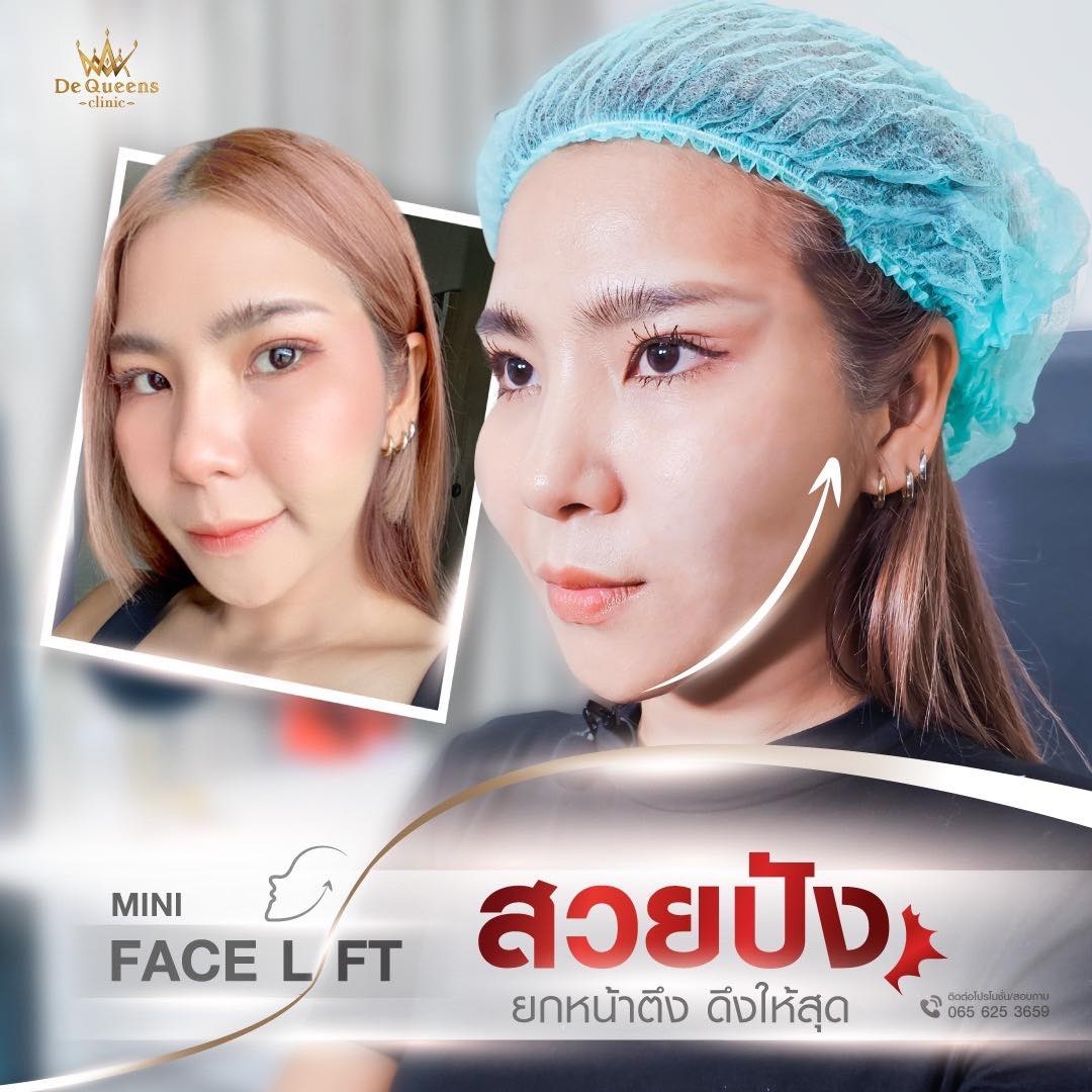 รวมเคสรีวิวร้อยไหมยกกระชับ Mini Face Lift ที่ De Queens Clinic