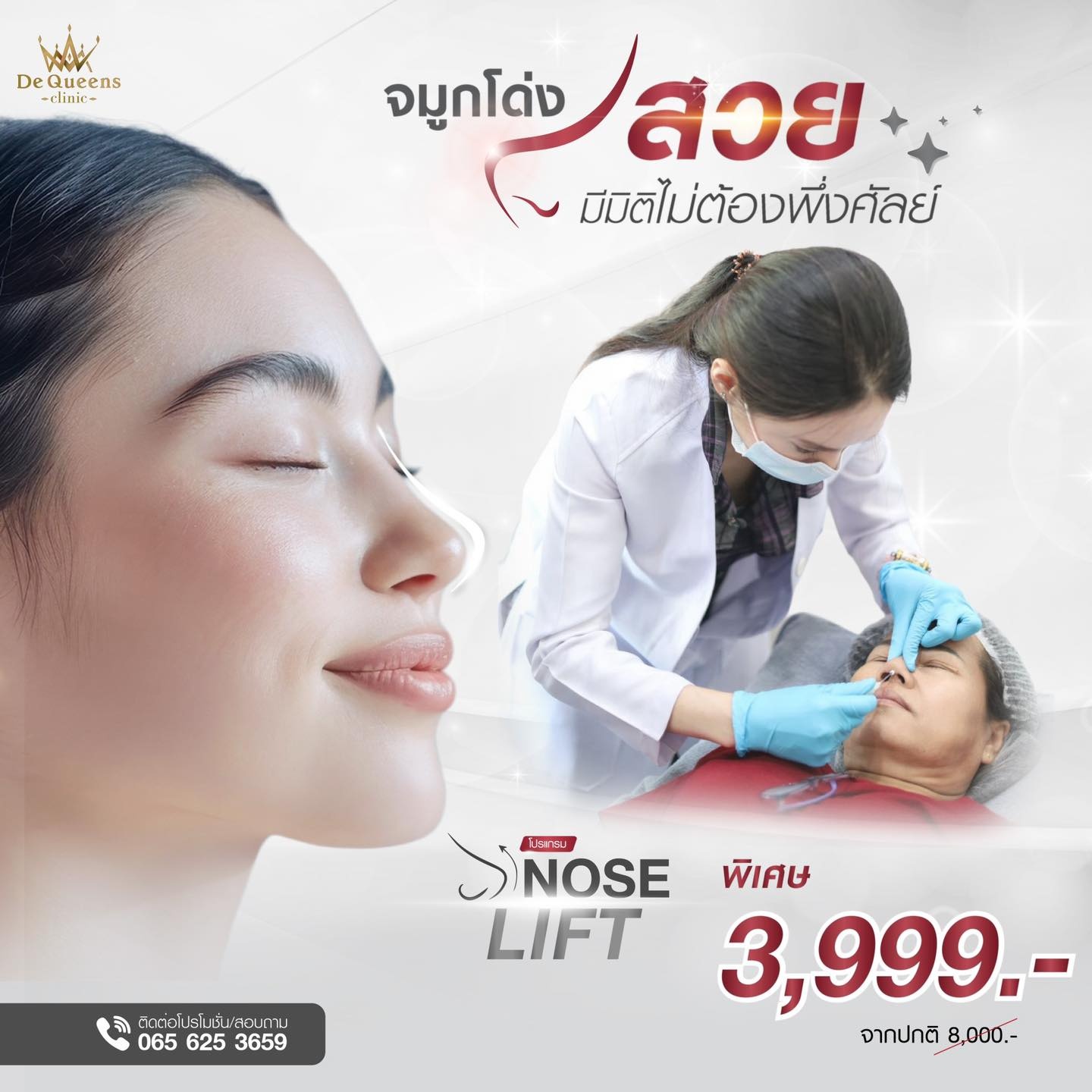 รวมเคสรีวิวร้อยไหมจมูก Nose Lift ที่ De Queens Clinic