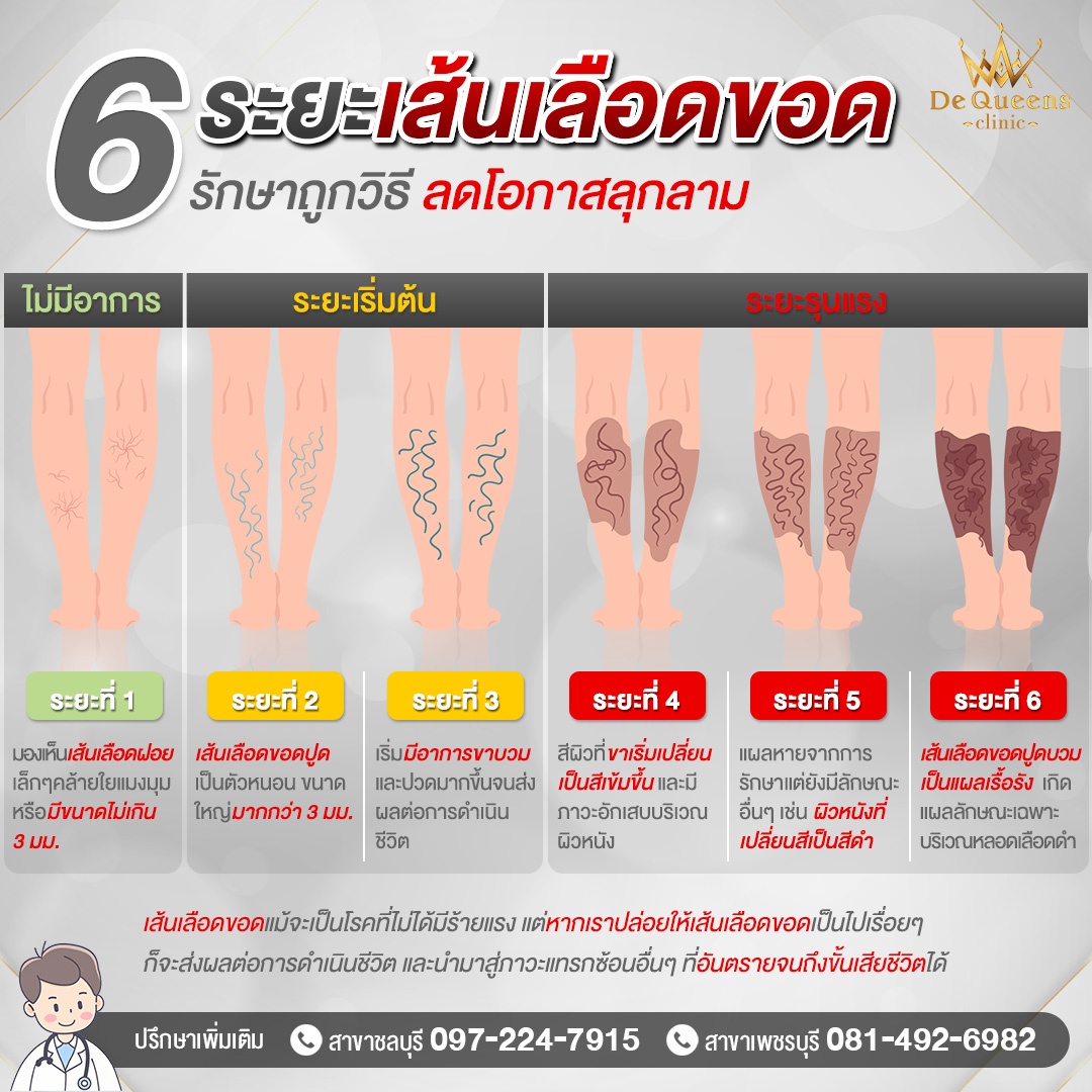 เป็นเส้นเลือดขอด ระยะ 2 ถึง ระยะ 3 ปวด ตึงขา หายได้ ไม่ต้องผ่าตัด