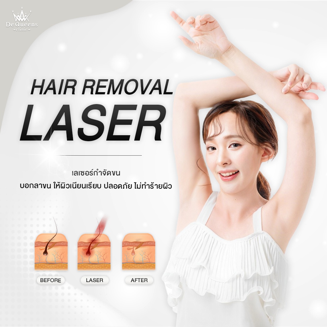 เลเซอร์กําจัดขน ชลบุรี  Hair Removal Laser - De Queens ชลบุรี เพชรบุรี