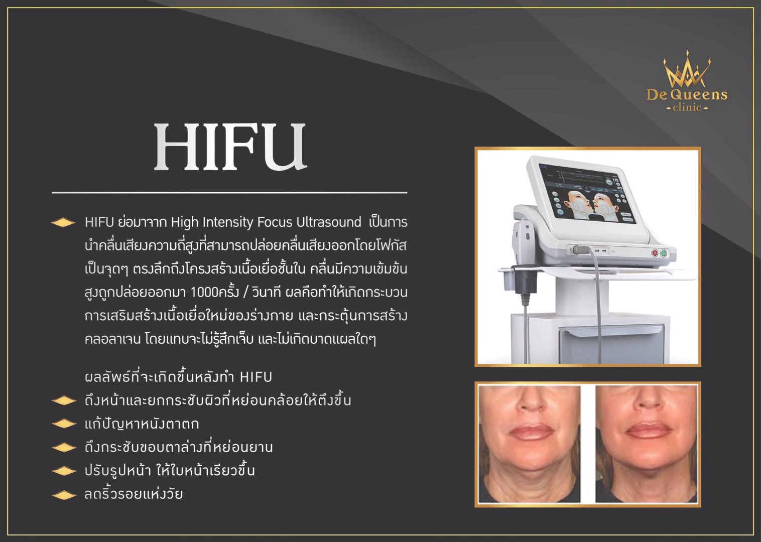 Ultra Max Lift ยกกระชับผิวหน้า (HIFU)