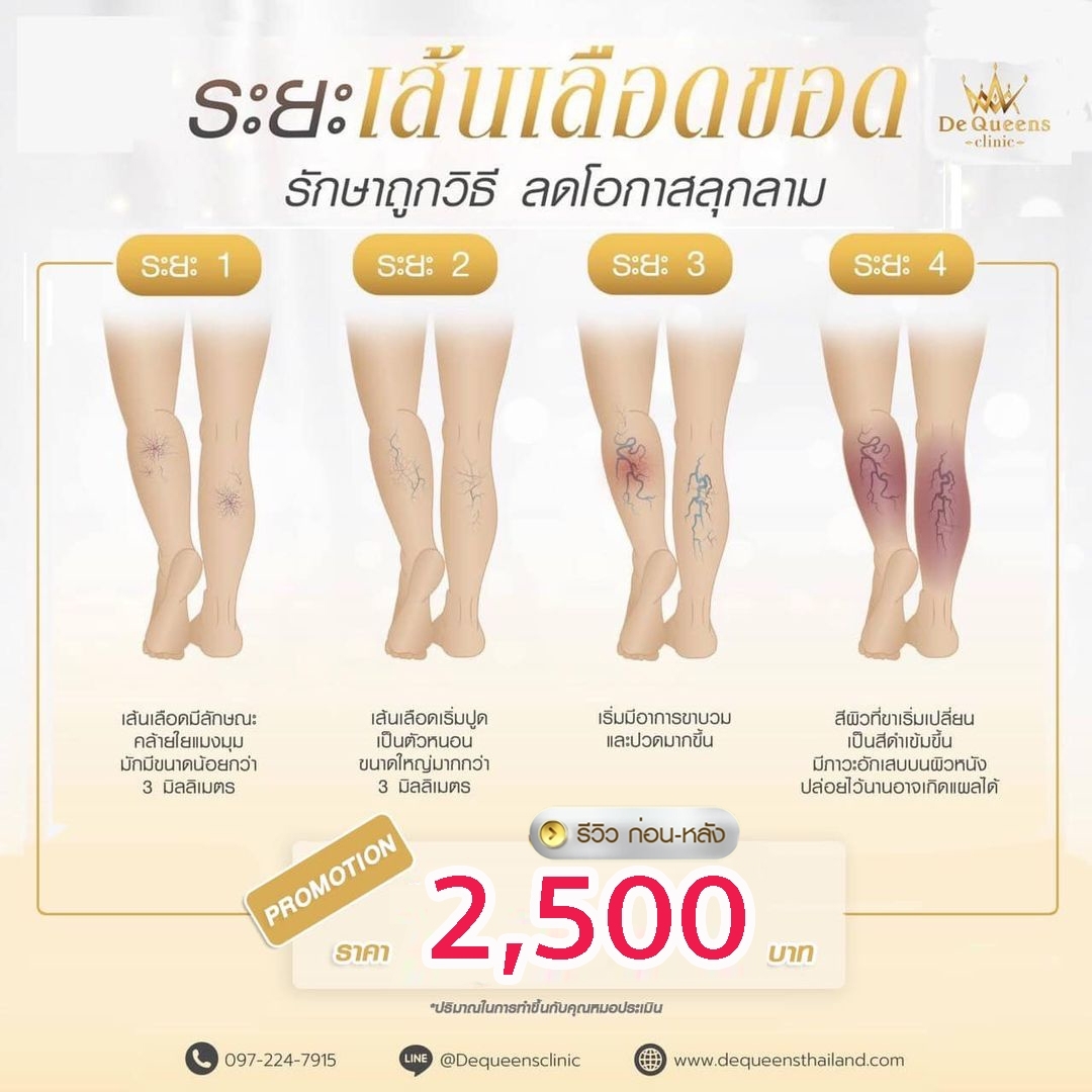 รักษาเส้นเลือดขอด
