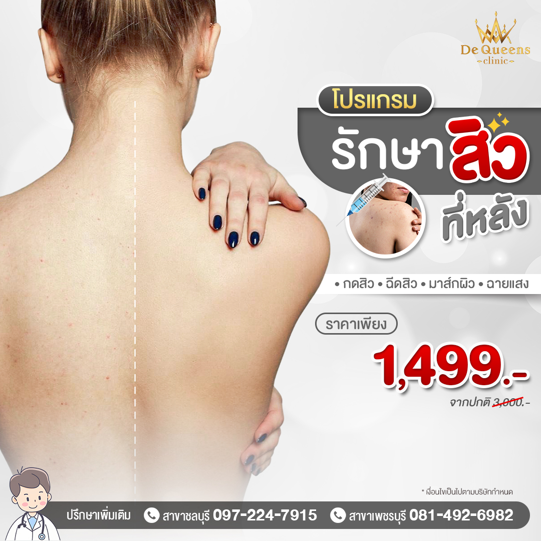 โปรโมชั่น รักษาสิวที่หลัง