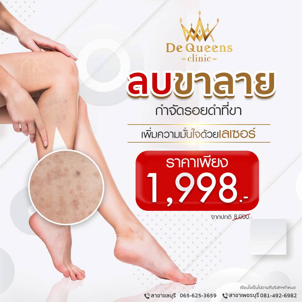 เลเซอร์ลบขาลาย กำจัดรอยดำที่ขา ที่ De Queens Clinic ชลบุรี และเพชรบุรี