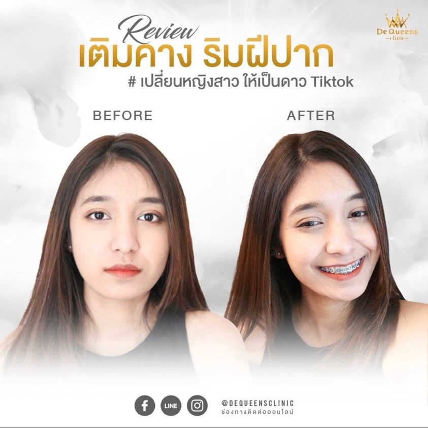 ฉีดฟิลเลอร์คาง ยังไงไม่ให้หน้าเรียวแบบไม่โป๊ะ!!