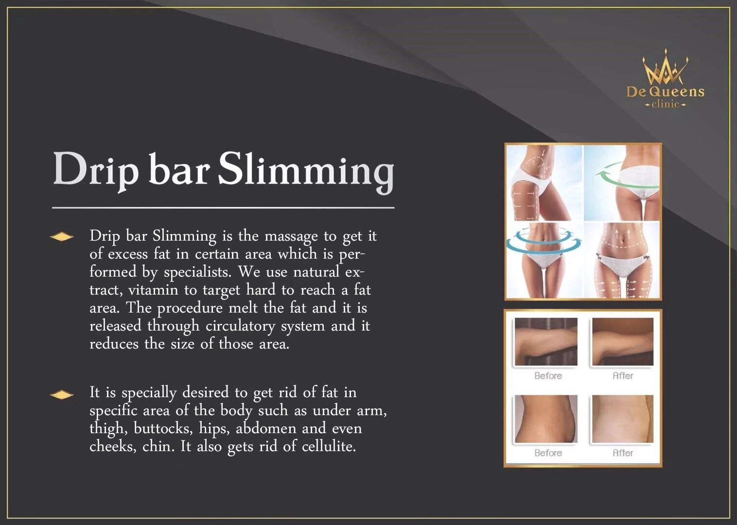 Drip bar Slimming